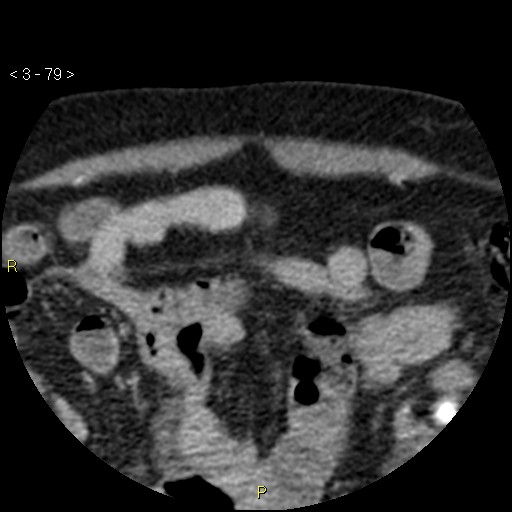 Aortoiliac occlusive disease (Radiopaedia 16828-16548 A 79).jpg