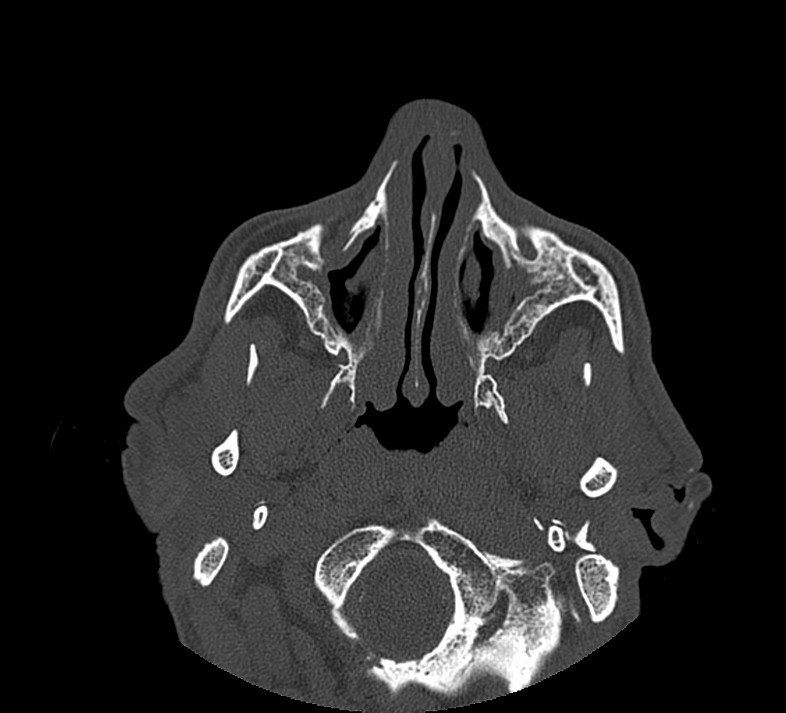 Aplastic maxillary sinuses (Radiopaedia 60030-67561 Axial non-contrast 25).jpg