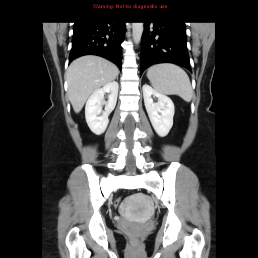 File:Appendiceal mucinous cystadenoma (Radiopaedia 8263-9111 B 51).jpg