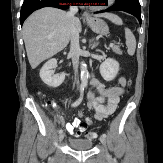 File:Appendicitis mass in inguinal hernia (Radiopaedia 26858-27029 B 35).jpg