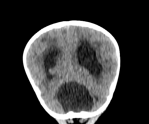 Arachnoid cyst-posterior fossa (Radiopaedia 88661-105370 Coronal non-contrast 59).jpg