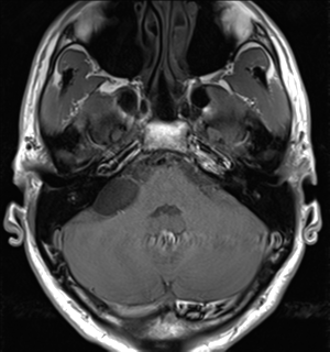 File:Arachnoid cyst - cerebellopontine angle (Radiopaedia 59689-67083 Axial T1 11).png