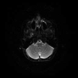 Arachnoid cyst - middle cranial fossa (Radiopaedia 86780-102938 Axial DWI 53).jpg