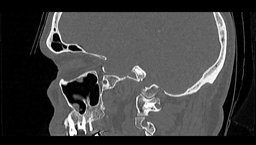 File:Arcuate foramen (Radiopaedia 89833-106944 Sagittal bone window 19).jpg