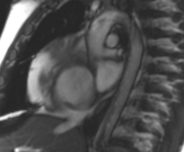 File:Arrhythmogenic right ventricular cardiomyopathy (Radiopaedia 69431-79307 Short axis cine 259).jpg
