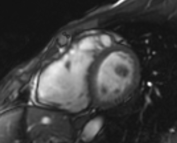 File:Arrhythmogenic right ventricular cardiomyopathy (Radiopaedia 69564-79464 short axis cine 150).jpg