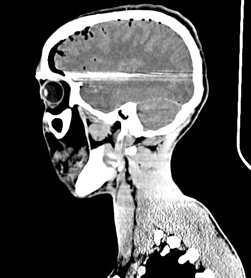 Arrow injury to the brain (Radiopaedia 72101-82607 H 45).jpg