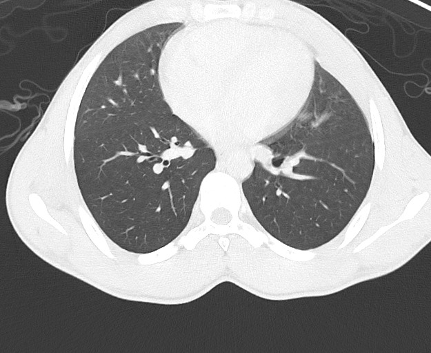 Arrow injury to the chest (Radiopaedia 75223-86321 Axial lung window 51).jpg