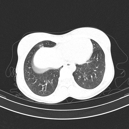 Arteria lusoria (Radiopaedia 88528-105192 Axial lung window 47).jpg