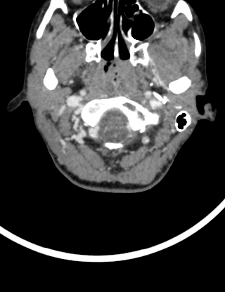 File:Arteriovenous malformation of the neck (Radiopaedia 53935-60062 B 1).jpg