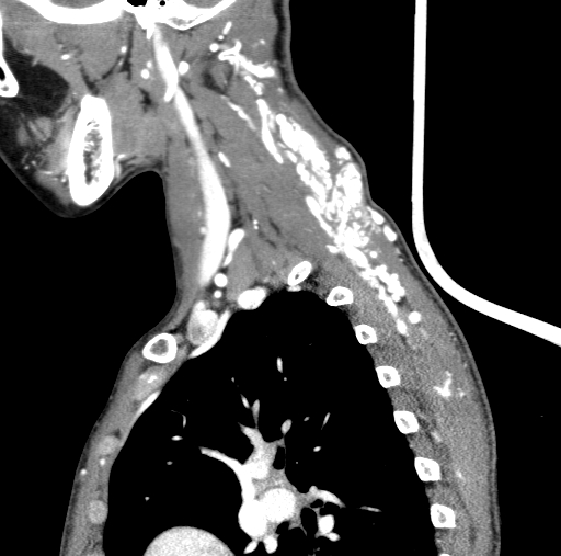 Arteriovenous malformation of the neck (Radiopaedia 53935-60062 C 31).jpg