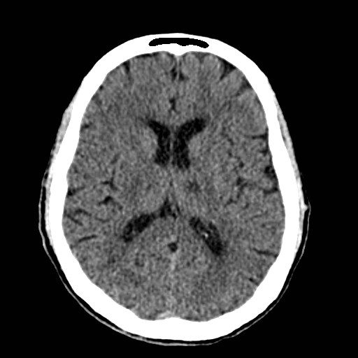 File:Artery of Percheron infarct (Radiopaedia 48088-52893 Axial non-contrast 24).jpg