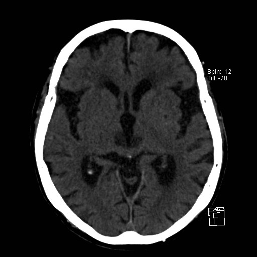 File:Artery of Percheron infarction (Radiopaedia 26307-26439 Axial non-contrast 13).jpg