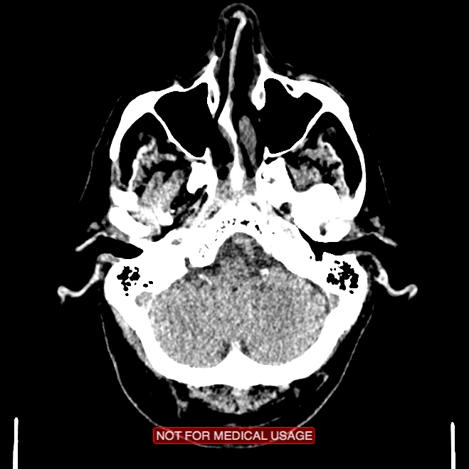 Artery of Percheron infarction (Radiopaedia 28679-28967 Axial non-contrast 21).jpg