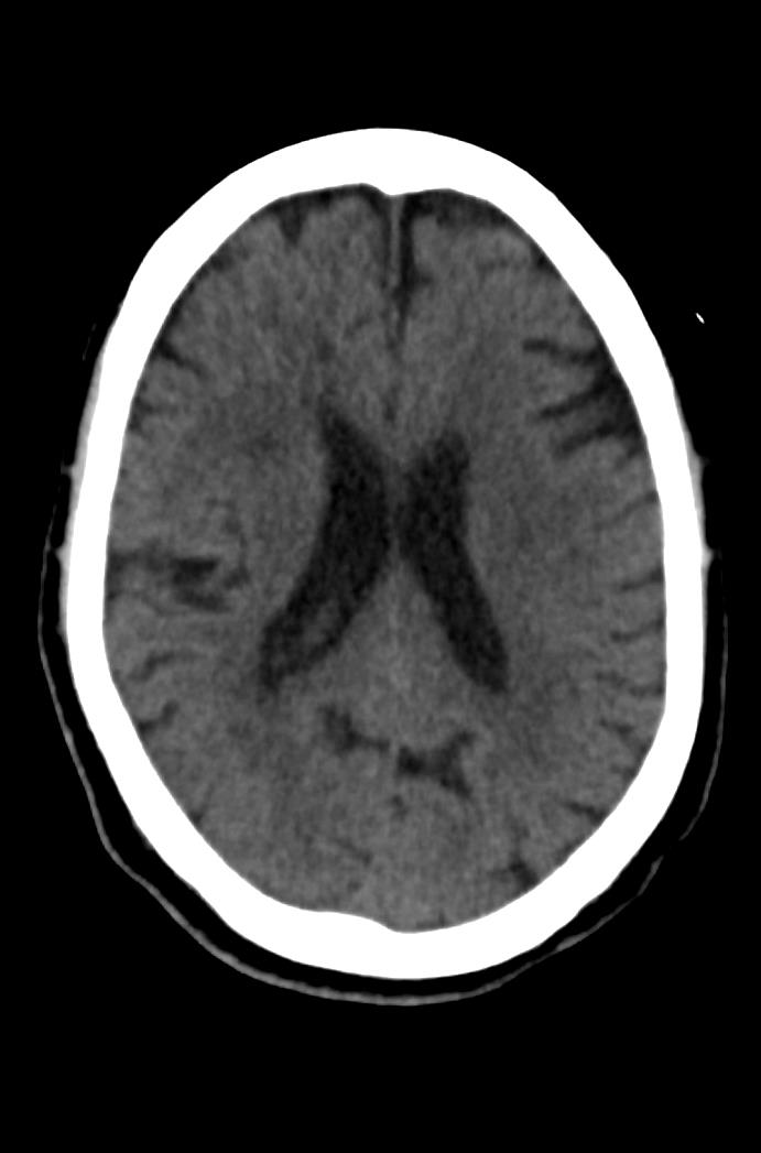 Artery of Percheron infarction (Radiopaedia 80613-94202 Axial non-contrast 118).jpg