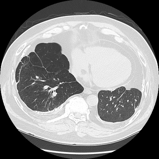 Asbestos-related pleural disease (Radiopaedia 74366-85250 Axial lung window 83).jpg