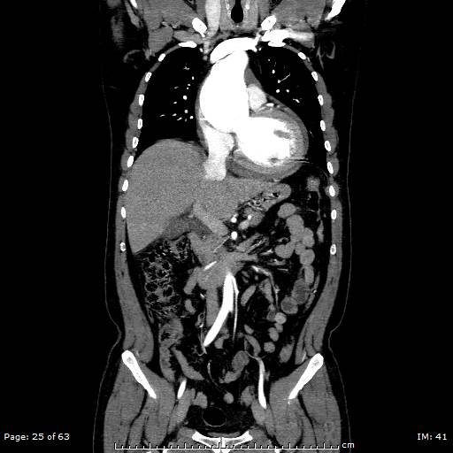 Ascending aortic aneurysm (Radiopaedia 50086-55404 B 25).jpg