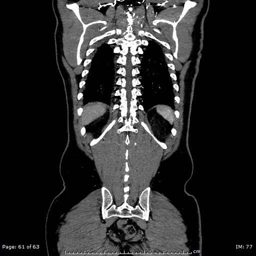 Ascending aortic aneurysm (Radiopaedia 50086-55404 B 61).jpg