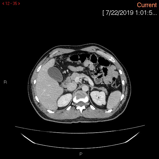 Ascending colonic diverticulum mimicking acute appendicitis (Radiopaedia 69943-80198 A 35).jpg
