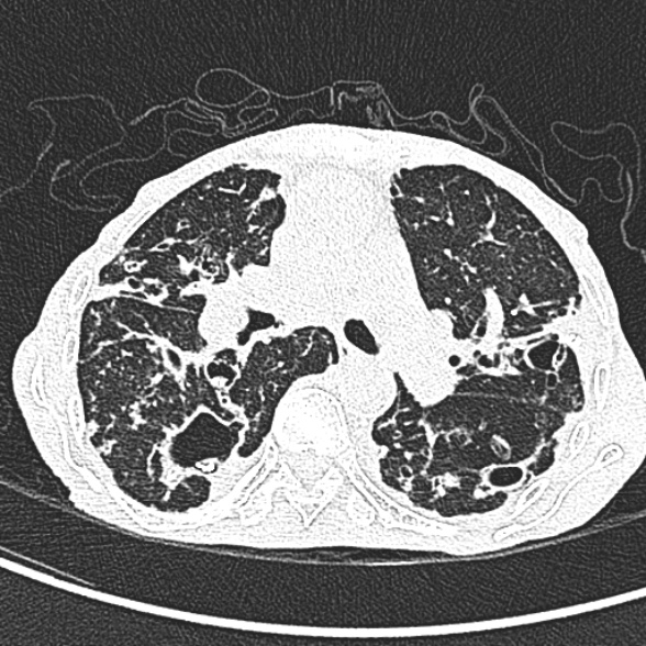 Aspergilloma- with Monod sign (Radiopaedia 44737-48532 Axial lung window 115).jpg