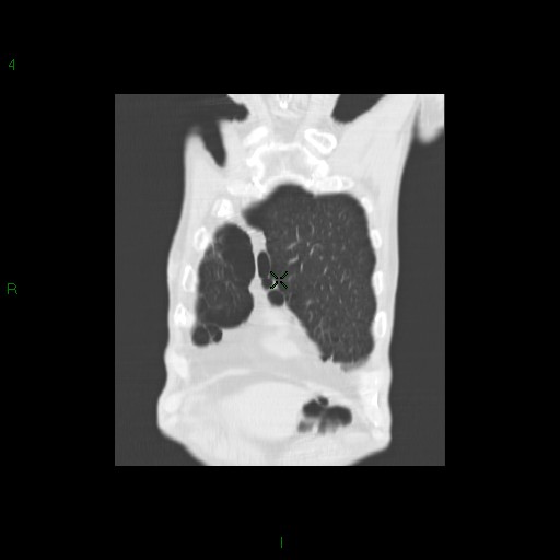 File:Aspergilloma (Radiopaedia 14842-14787 Coronal lung window 5).jpg
