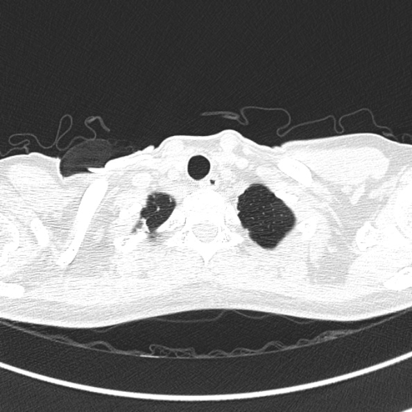 Aspergilloma (Radiopaedia 26223-26347 Axial lung window 4).jpg