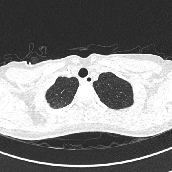 Aspergilloma (Radiopaedia 26223-26347 Axial lung window 9).jpg