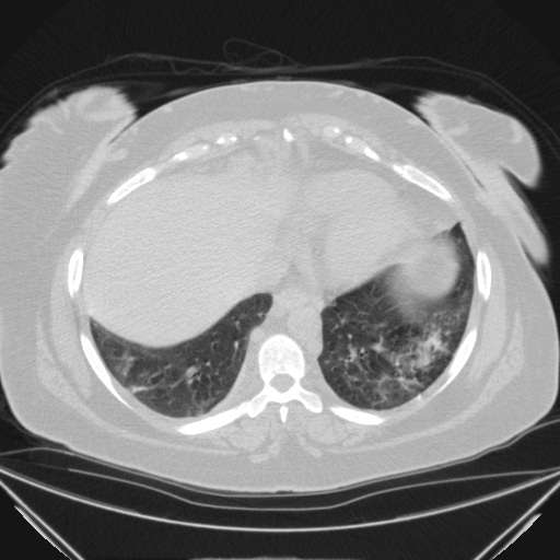Aspergilloma (Radiopaedia 39611-41932 Axial lung window 104).jpg