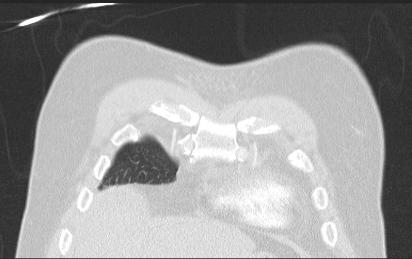 Aspirated tooth (Radiopaedia 28584-28844 Axial lung window 27).jpg