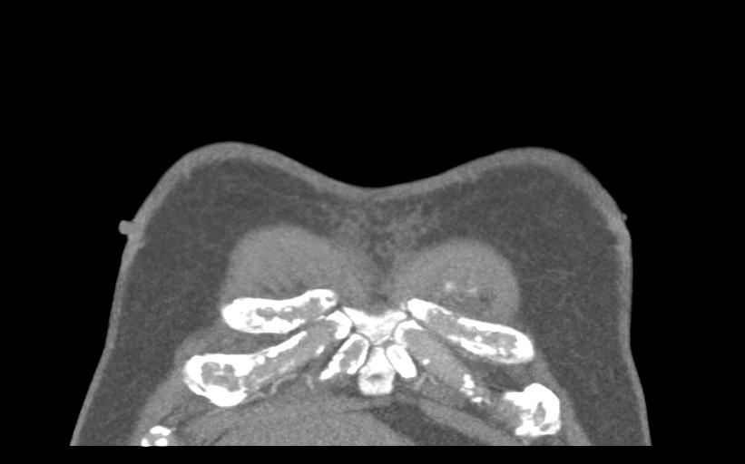 Aspirated tooth (Radiopaedia 28584-28844 Coronal C+ CTPA 4).jpg