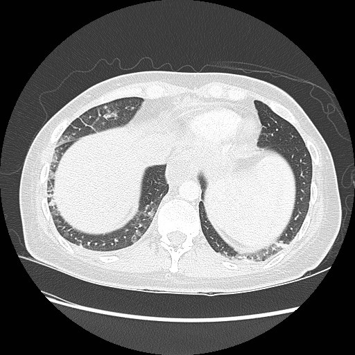 Aspiration pneumonia secondary to laparoscopic banding (Radiopaedia 18345-18183 lung window 92).jpg