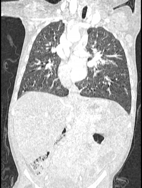 Asplenia syndrome (Radiopaedia 73083-83792 Coronal lung window 72).jpg