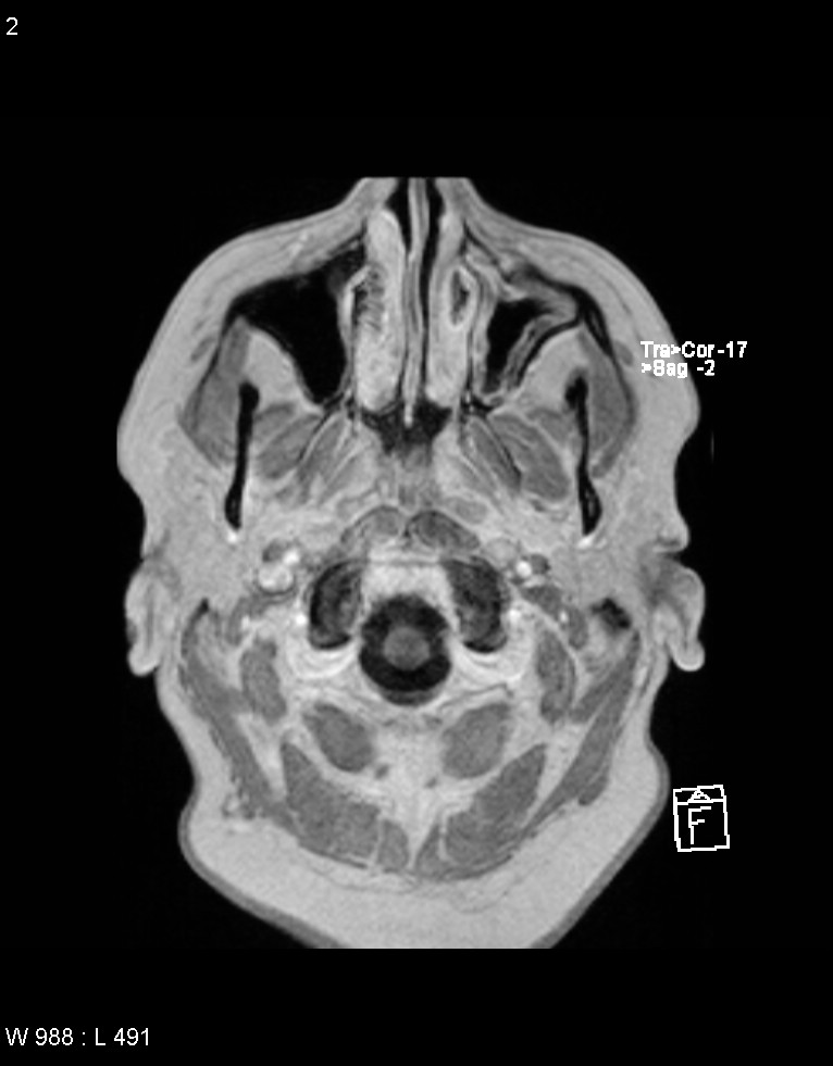 Astroblastoma (Radiopaedia 39792-42217 Axial T1 C+ 1).jpg