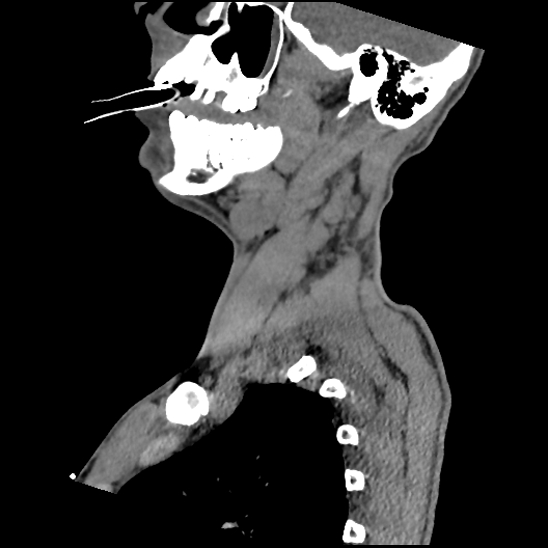 Atlanto-occipital dissociation (Traynelis type 1), C2 teardrop fracture, C6-7 facet joint dislocation (Radiopaedia 87655-104061 D 23).jpg
