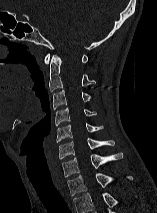 Atlantoaxial subluxation (Radiopaedia 44681-48450 Sagittal bone window 72).jpg