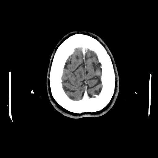 Atretic cephalocele (Radiopaedia 89782-106881 Axial with contrast 170).jpg