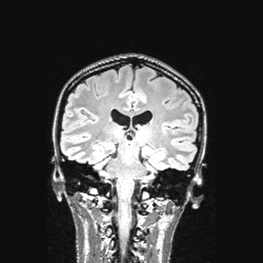 Atretic encephalocoele with inferior vermis hypoplasia (Radiopaedia 30443-31108 Coronal FLAIR 80).jpg