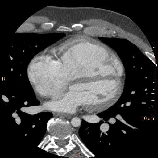 Atrial septal defect (upper sinus venosus type) with partial anomalous pulmonary venous return into superior vena cava (Radiopaedia 73228-83961 A 151).jpg
