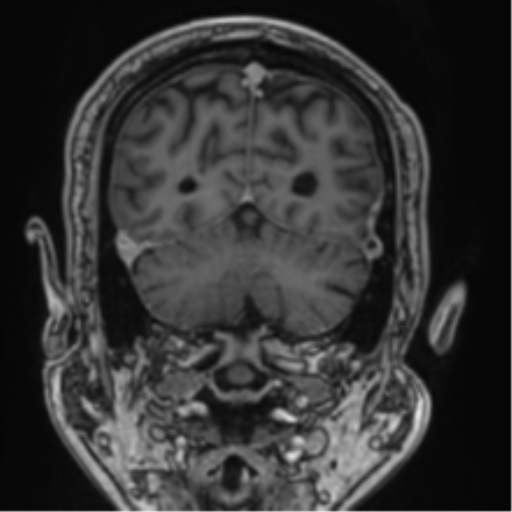 File:Atypical meningioma (WHO grade II) with brain invasion (Radiopaedia 57767-64729 Coronal T1 C+ 66).png
