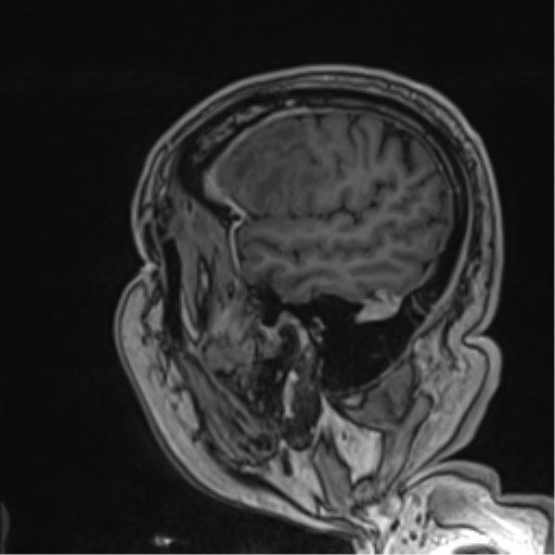 Atypical meningioma (WHO grade II) with brain invasion (Radiopaedia 57767-64729 Sagittal T1 C+ 54).png