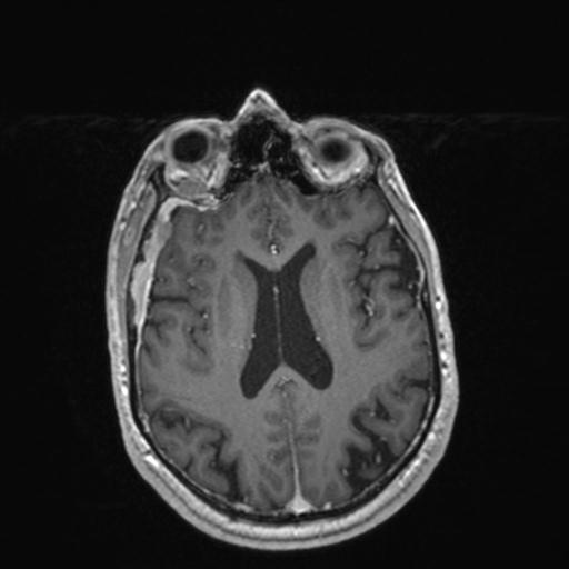 Atypical meningioma (grade II) - en plaque (Radiopaedia 29633-30147 Axial T1 C+ 116).jpg
