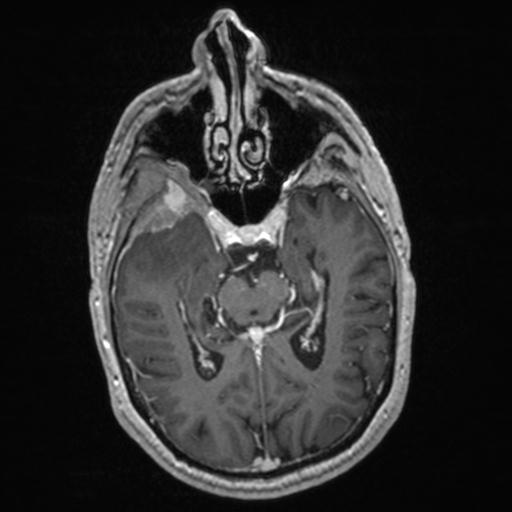 Atypical meningioma (grade II) - en plaque (Radiopaedia 29633-30147 Axial T1 C+ 81).jpg