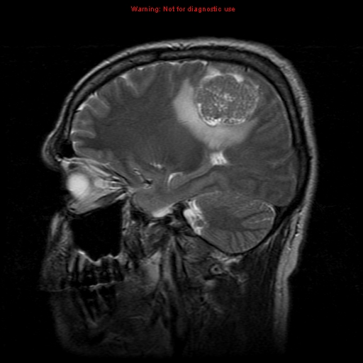 File:Atypical meningioma - grade II (Radiopaedia 13303-13305 Sagittal T2 8).jpg