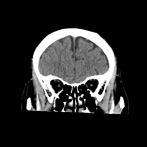 Atypical meningioma with skull invasion (Radiopaedia 34357-35649 Coronal non-contrast 18).png
