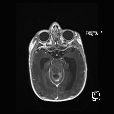 Atypical teratoid rhabdoid tumor (prenatal US and neonatal MRI) (Radiopaedia 59091-66388 Axial T1 C+ 24).jpg