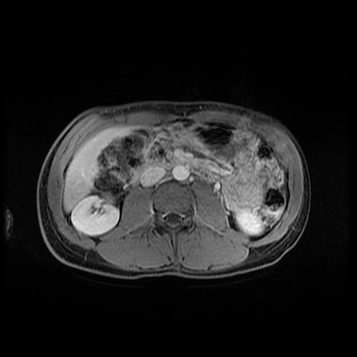 Autoimmune pancreatitis (Radiopaedia 69751-79729 M 88).jpg