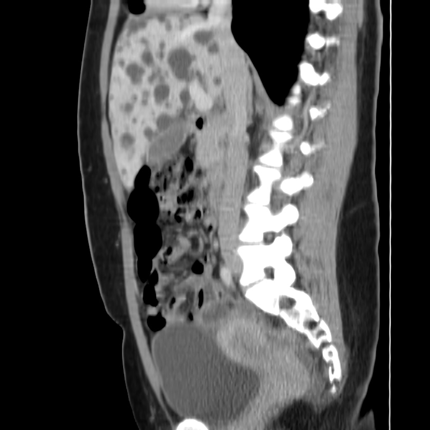 Autosomal dominant polycystic kidney disease (Radiopaedia 23061-23093 F 24).jpg