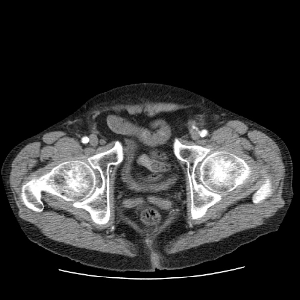 Autosomal dominant polycystic kidney disease (Radiopaedia 27851-28094 B 117).jpg