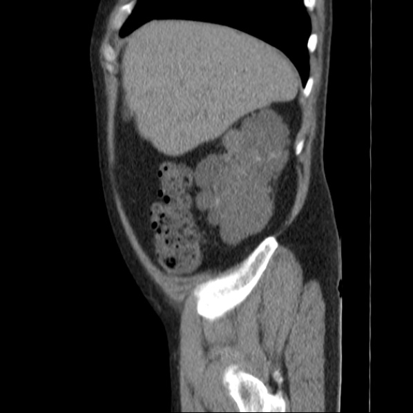 File:Autosomal dominant polycystic kidney disease (Radiopaedia 36539-38101 D 17).jpg