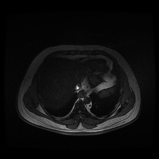Autosomal dominant polycystic kidney disease (Radiopaedia 50259-55611 Axial 2D Dual Echo 11).jpg